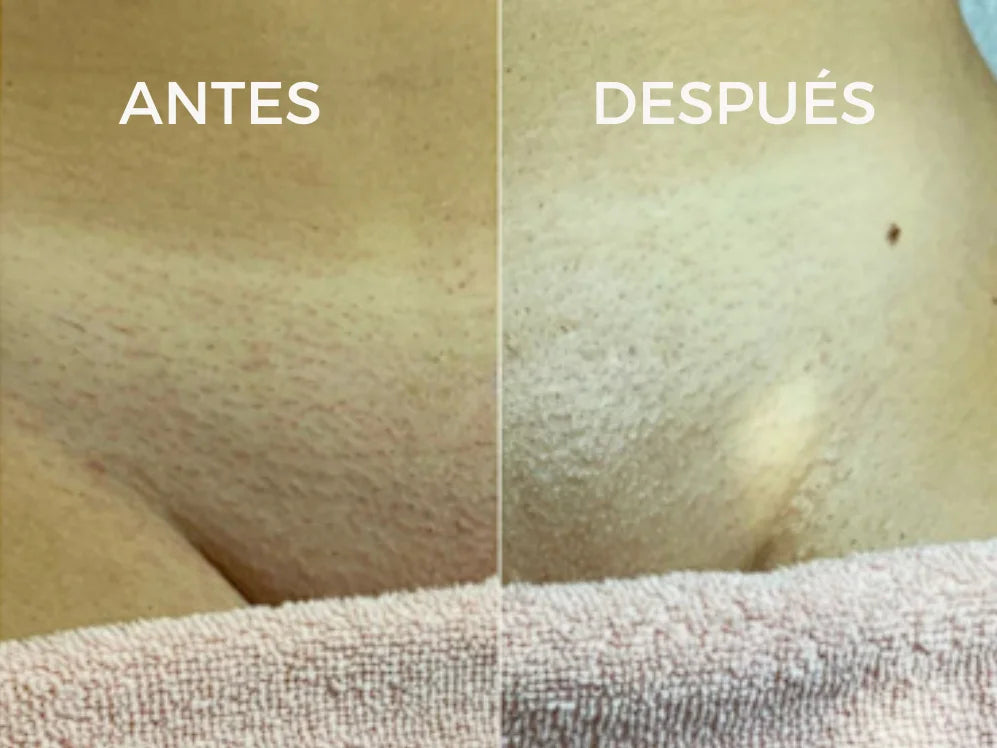 CYPERUS OIL® | Elimina de raíz el vello no deseado ✨