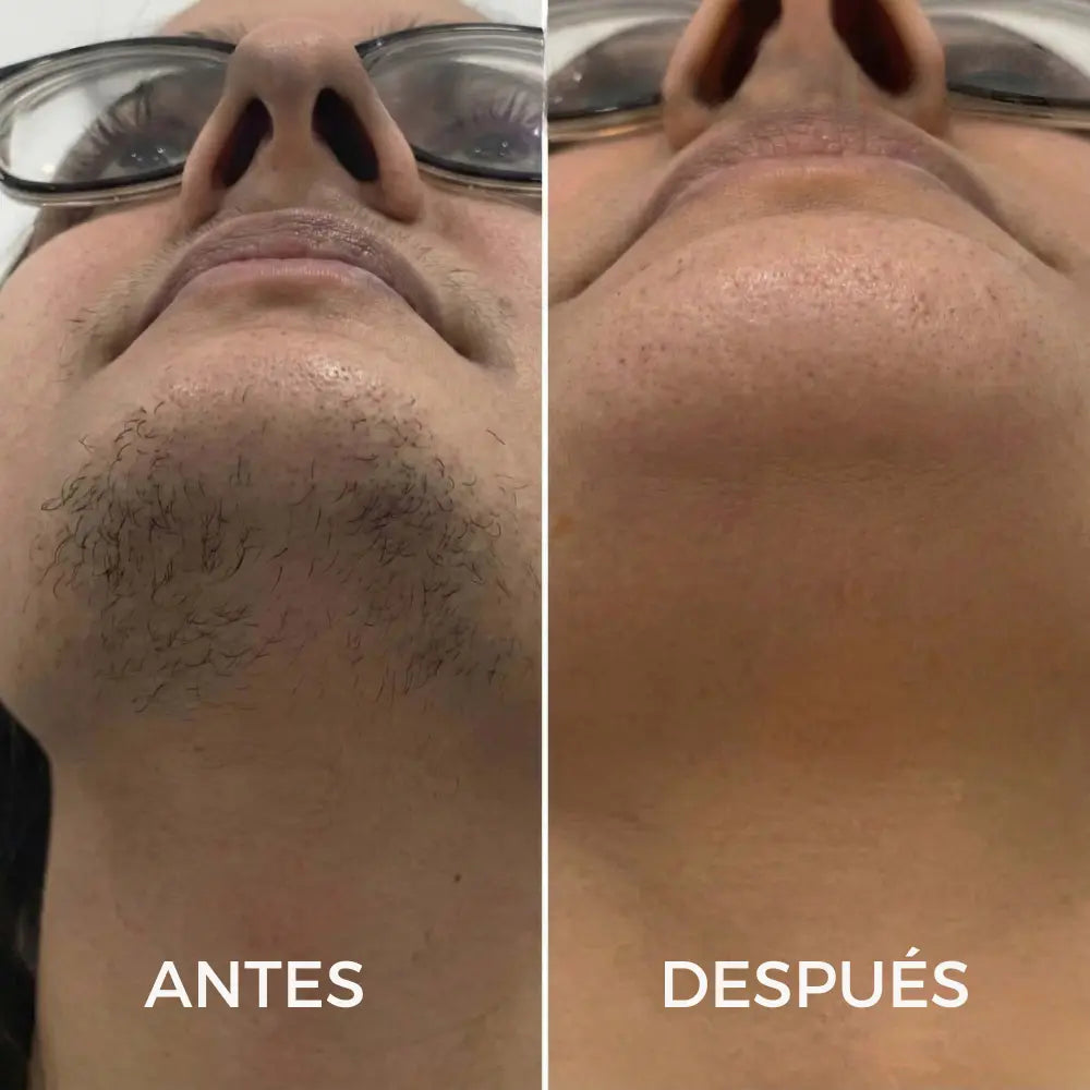 CYPERUS OIL® | Elimina de raíz el vello no deseado ✨