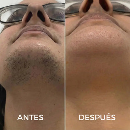 CYPERUS OIL® | Elimina de raíz el vello no deseado ✨