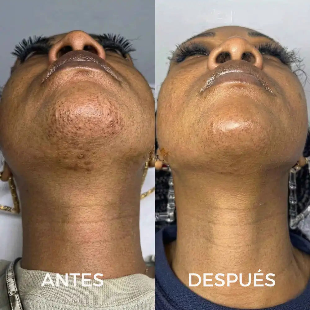 CYPERUS OIL® | Elimina de raíz el vello no deseado ✨
